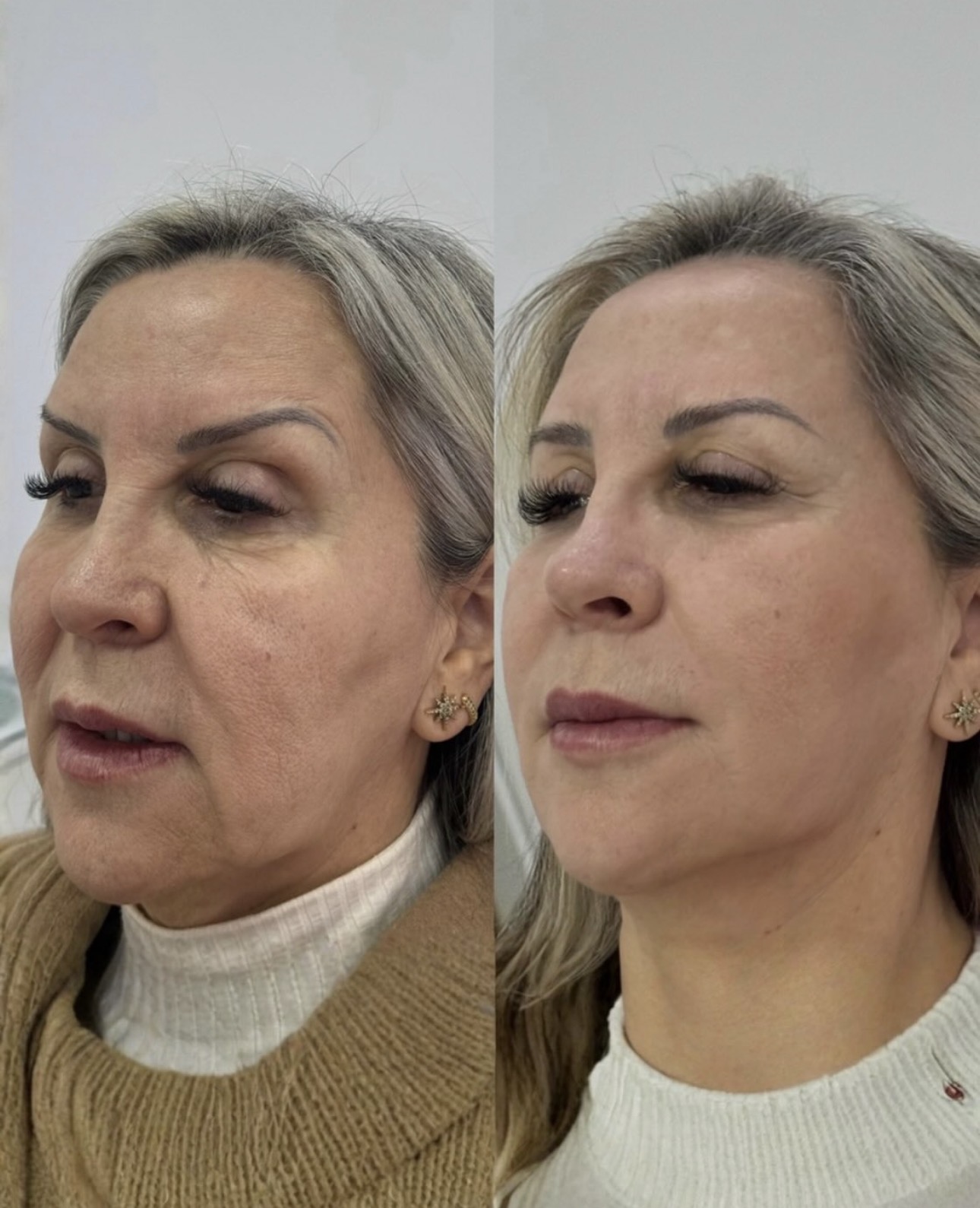 Antes e Depois 3